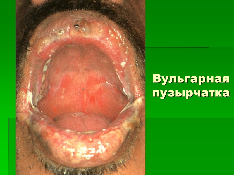 Вульгарная пузырчатка